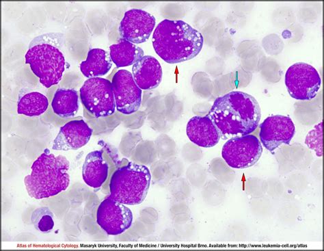 burkitt's lymphoma peripheral smear.